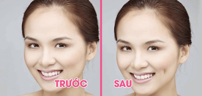 hình ảnh trước và sau khi thực hiện tạo má núm