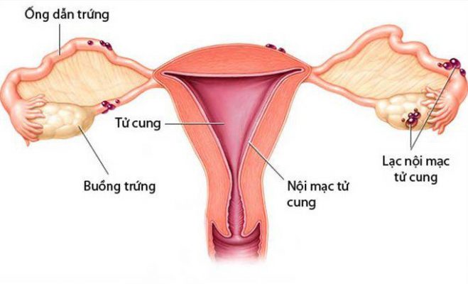 lạc nội mạc tử cung