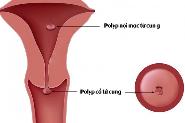 polyp cổ tử cung là gì