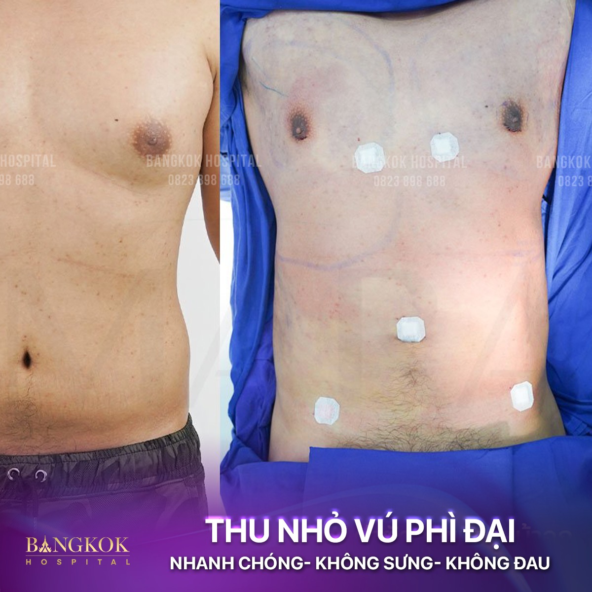 phẫu thuật phì đại tuyến vú