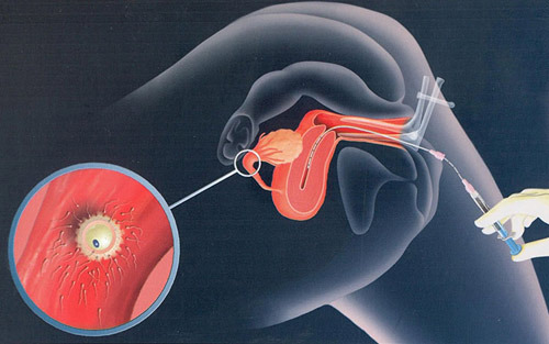 thụ tinh nhân tạo IUI