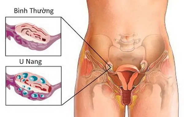 u nang buồng trứng có nguy hiểm không