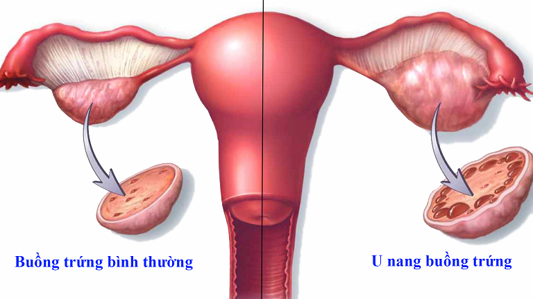 u nang buồng trứng