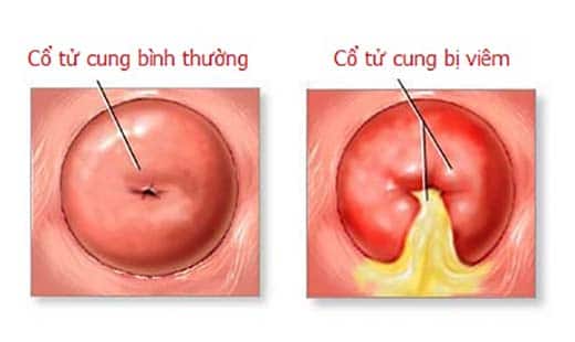 viêm cổ tử cung